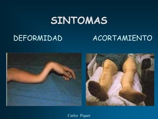 SINTOMAS
DEFORMIDAD                   ACORTAMIENTO




             Carlos Piquer
 
