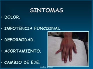 SINTOMAS
• DOLOR.

• IMPOTENCIA FUNCIONAL.

• DEFORMIDAD.

• ACORTAMIENTO.

• CAMBIO DE EJE.
                Carlos Piquer
 