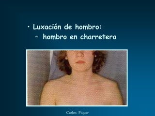 • Luxación de hombro:
   – hombro en charretera




          Carlos Piquer
 