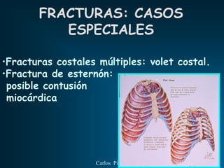 FRACTURAS: CASOS
          ESPECIALES

•Fracturas costales múltiples: volet costal.
•Fractura de esternón:
 posible contusión
 miocárdica




                   Carlos Piquer
 