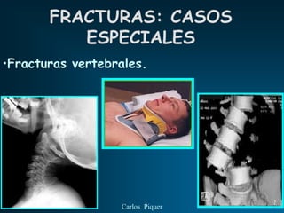 FRACTURAS: CASOS
          ESPECIALES
•Fracturas vertebrales.




                  Carlos Piquer
 