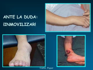 ANTE LA DUDA:
¡INMOVILIZAR!




                Carlos Piquer
 