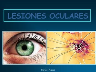 LESIONES OCULARES




       Carlos Piquer
 