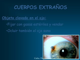 CUERPOS EXTRAÑOS

Objeto clavado en el ojo:
  •Fijar con gasas estériles y vendar
  •Ocluir también el ojo sano




                   Carlos Piquer
 