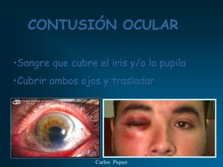 CONTUSIÓN OCULAR

•Sangre que cubre el iris y/o la pupila
•Cubrir ambos ojos y trasladar




                  Carlos Piquer
 