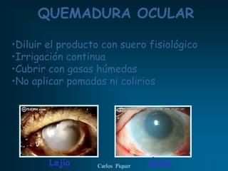 QUEMADURA OCULAR

•Diluir el producto con suero fisiológico
•Irrigación continua
•Cubrir con gasas húmedas
•No aplicar pomadas ni colirios




        Lejía     Carlos Piquer   Ácido
 