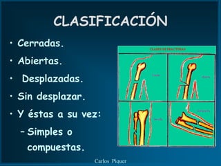CLASIFICACIÓN
• Cerradas.
• Abiertas.
• Desplazadas.
• Sin desplazar.
• Y éstas a su vez:
  – Simples o
   compuestas.
                   Carlos Piquer
 