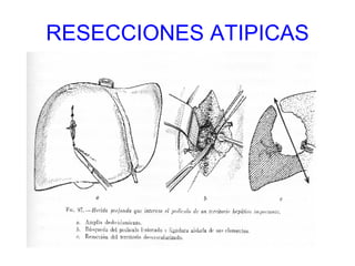 RESECCIONES ATIPICAS 