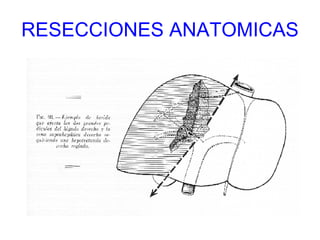 RESECCIONES ANATOMICAS 