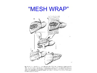 “ MESH WRAP” 