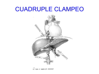 CUADRUPLE CLAMPEO 