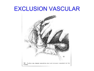 EXCLUSION VASCULAR 