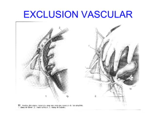 EXCLUSION VASCULAR 