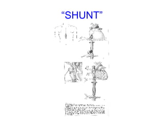 “ SHUNT” 