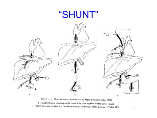 “ SHUNT” 
