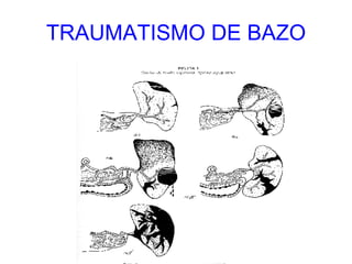 TRAUMATISMO DE BAZO 