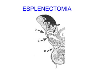 ESPLENECTOMIA 