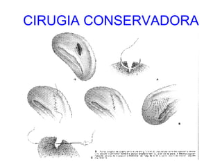 CIRUGIA CONSERVADORA 