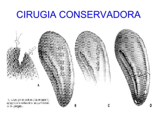 CIRUGIA CONSERVADORA 