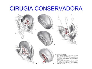 CIRUGIA CONSERVADORA 