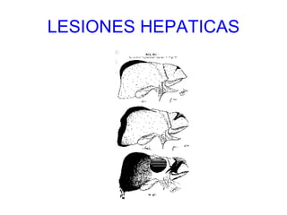 LESIONES HEPATICAS 