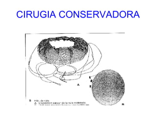 CIRUGIA CONSERVADORA 