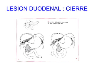 LESION DUODENAL : CIERRE 