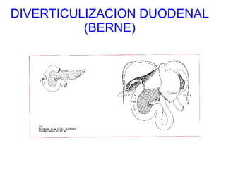 DIVERTICULIZACION DUODENAL (BERNE) 