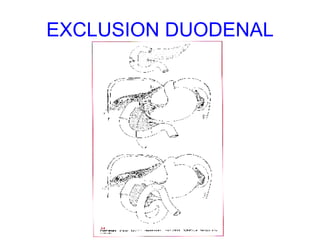 EXCLUSION DUODENAL 