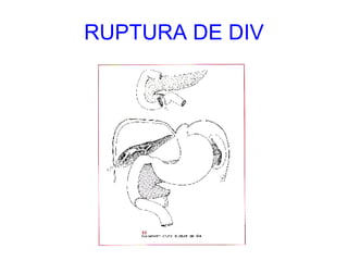 RUPTURA DE DIV 