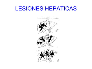 LESIONES HEPATICAS 