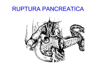RUPTURA PANCREATICA 