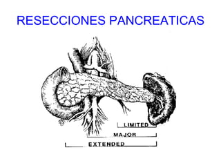 RESECCIONES PANCREATICAS 