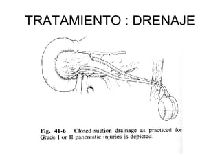 TRATAMIENTO : DRENAJE 