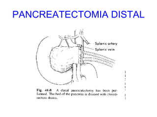 PANCREATECTOMIA DISTAL 