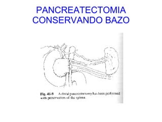 PANCREATECTOMIA CONSERVANDO BAZO 