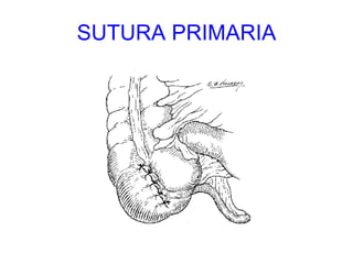 SUTURA PRIMARIA 