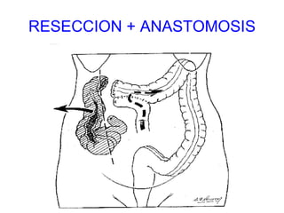 RESECCION + ANASTOMOSIS 