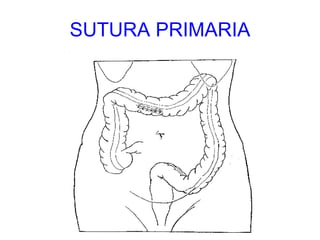 SUTURA PRIMARIA 