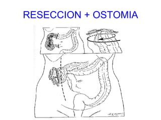 RESECCION + OSTOMIA 
