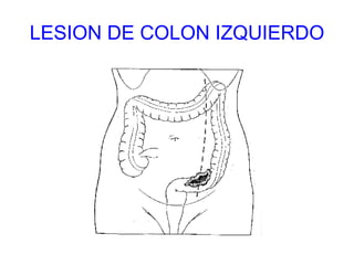 LESION DE COLON IZQUIERDO 