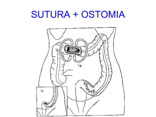 SUTURA + OSTOMIA 