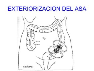 EXTERIORIZACION DEL ASA 