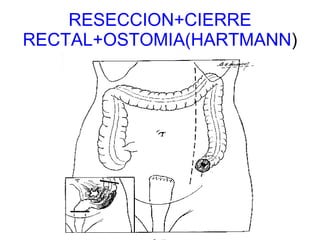 RESECCION+CIERRE RECTAL+OSTOMIA(HARTMANN ) 