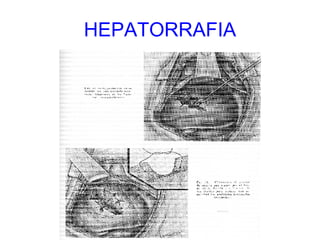 HEPATORRAFIA 