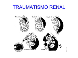 TRAUMATISMO RENAL 