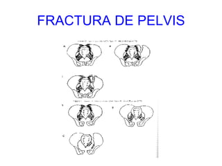 FRACTURA DE PELVIS 