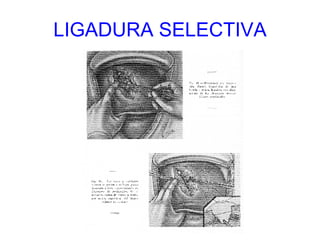 LIGADURA SELECTIVA 