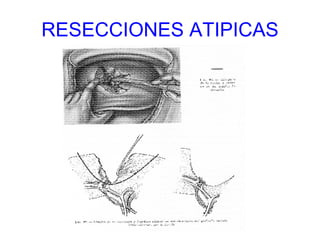 RESECCIONES ATIPICAS 