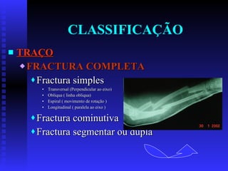 CLASSIFICAÇÃO TRAÇO FRACTURA COMPLETA Fractura simples Transversal (Perpendicular ao eixo) Obliqua ( linha obliqua) Espiral ( movimento de rotação ) Longitudinal ( paralela ao eixo ) Fractura cominutiva  Fractura segmentar ou dupla 